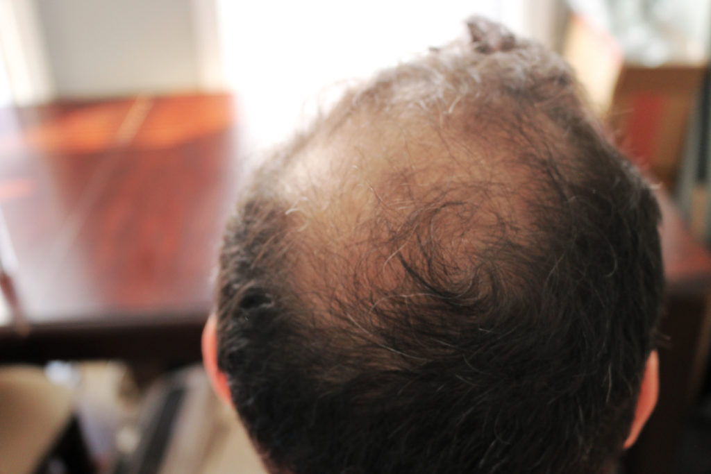 What You Need to Know About Temporary and Permanent  Hair Loss